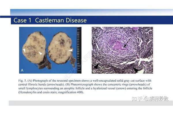 浆细胞castleman病,卡斯曼病早期需要多次化疗